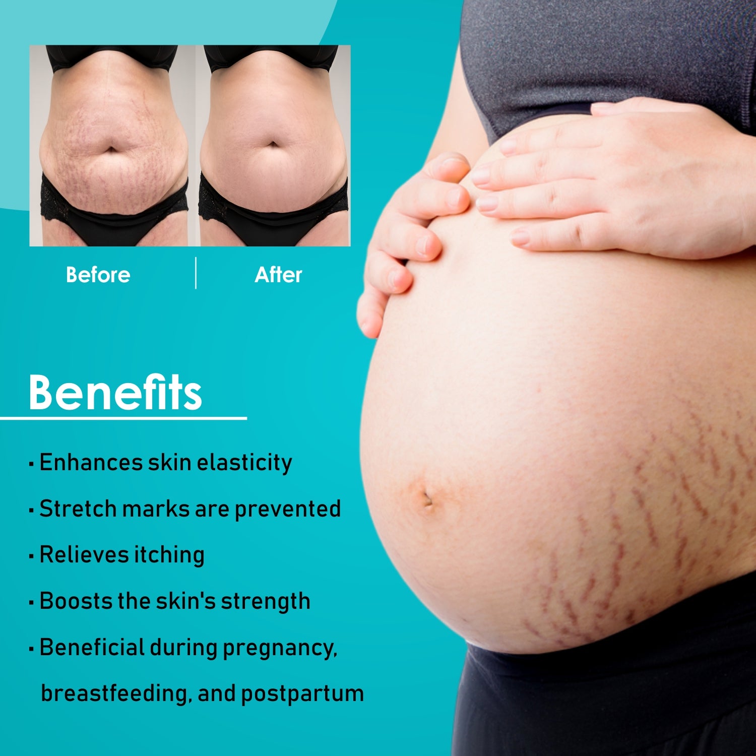 Mildcares Stretch Mark Removal Oil (100ml) With Goodness of Sunflower Oil, Vitamin C